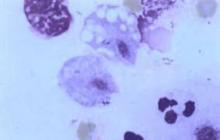 Trichomoniasis Frotis Directo