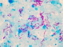 Tinción ZIELH NEELSEN